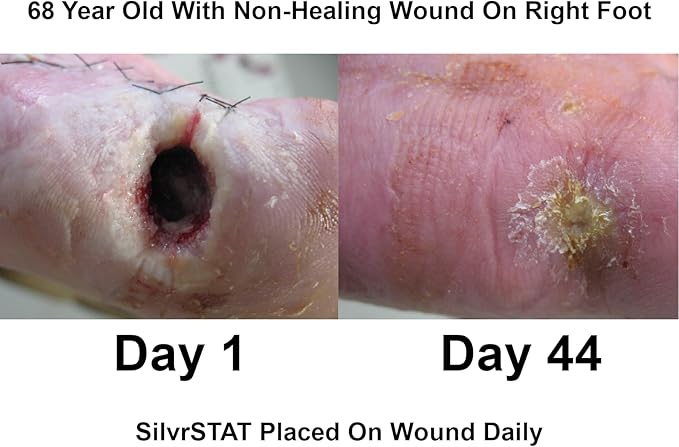 SilvrSTAT First Aid Kit Gel, 32 PPM Silver Healing Wound Dressing Solution, SilverSol Ag₄O₄ Particles, 3 oz